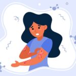 Imbau Warga Berau Waspada Cacar Monyet