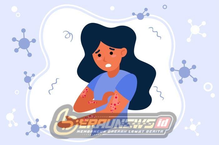 Imbau Warga Berau Waspada Cacar Monyet