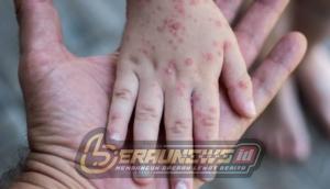 Kasus Suspek Campak di Berau Naik Jadi 58, Dinkes Tunggu Hasil Laboratorium